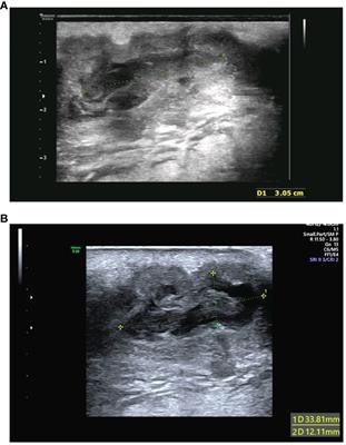 Case report: A rare case of skin abscess caused by coinfection of Actinobaculum schaalii and Actinomyces turicensis